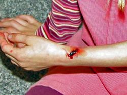 Lotus slachtoffer met een verwonding